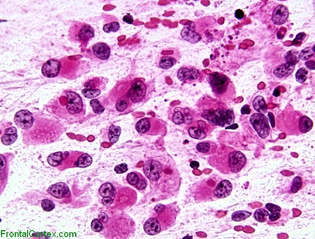 Atypical teratoid/rhabdoid tumor, intraoperative smear preparation x 400 (H&E stain).